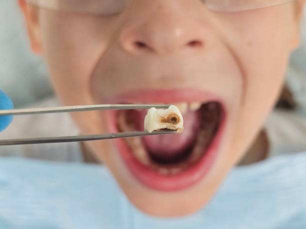 Best Broken or Cracked Tooth Emergency Dentist in Cape St Claire, MD